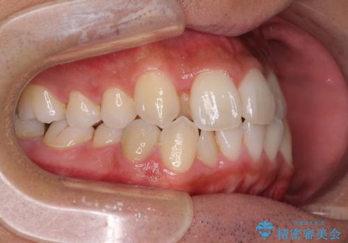 【モニター】左右のクロスバイトをインビザラインできれいに改善の治療前