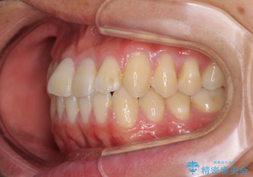 軽微なデコボコを安価に インビザライン・ライトによる矯正治療の治療前