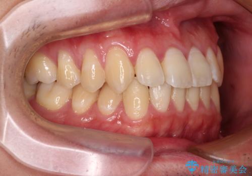 軽微なデコボコを安価に インビザライン・ライトによる矯正治療の治療後