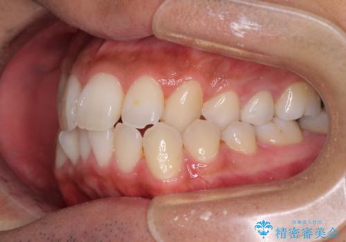 【モニター】左右のクロスバイトをインビザラインできれいに改善の治療前