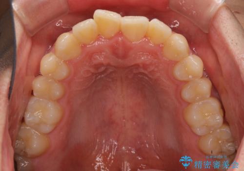 軽微なデコボコを安価に インビザライン・ライトによる矯正治療の治療前