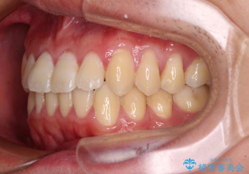 軽微なデコボコを安価に インビザライン・ライトによる矯正治療の治療後