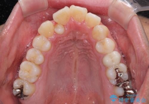 【モニター】左右のクロスバイトをインビザラインできれいに改善の治療前