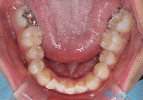 【モニター】左右のクロスバイトをインビザラインできれいに改善の治療前