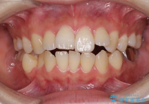 目立たない裏側矯正で突出感を改善 ハーフリンガル矯正の症例 治療前