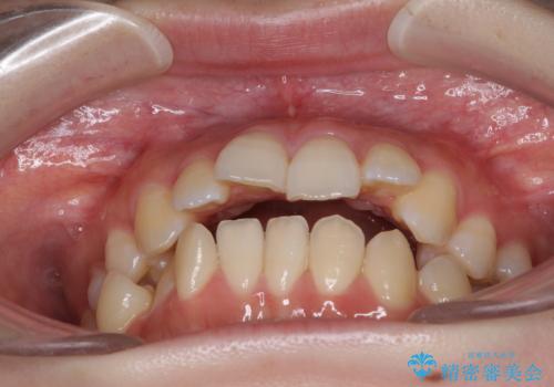 目立たない裏側矯正で突出感を改善 ハーフリンガル矯正の治療前