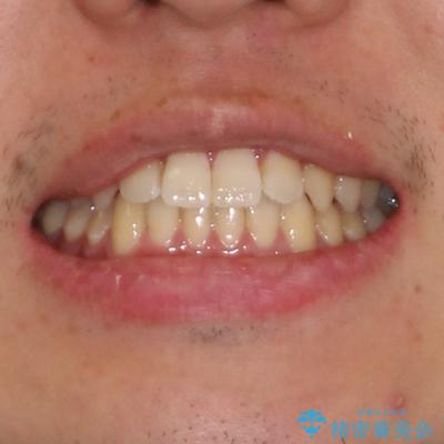軽微なデコボコを安価に インビザライン・ライトによる矯正治療の治療後(顔貌)