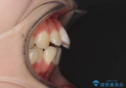 目立たない裏側矯正で突出感を改善 ハーフリンガル矯正の治療前