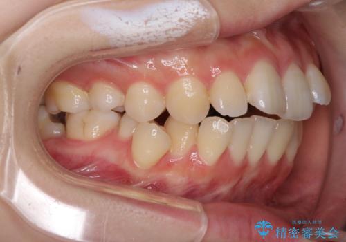 目立たない裏側矯正で突出感を改善 ハーフリンガル矯正の治療前