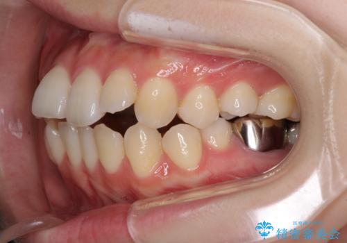 目立たない裏側矯正で突出感を改善 ハーフリンガル矯正の治療前