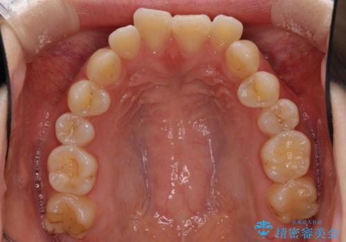 目立たない裏側矯正で突出感を改善 ハーフリンガル矯正の治療前