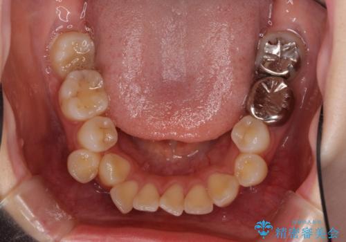 目立たない裏側矯正で突出感を改善 ハーフリンガル矯正の治療前