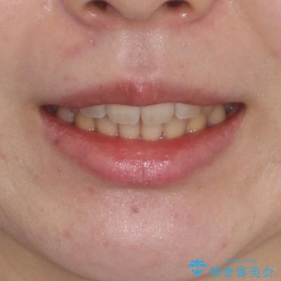 捻れた前歯をインビザラインでスッキリとの治療後(顔貌)