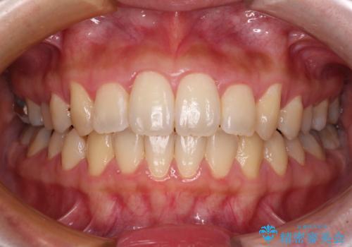 捻れた前歯をインビザラインでスッキリとの症例 治療後