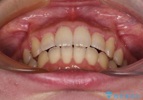 捻れた前歯をインビザラインでスッキリとの治療後