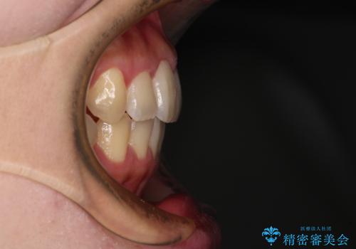 捻れた前歯をインビザラインでスッキリとの治療後