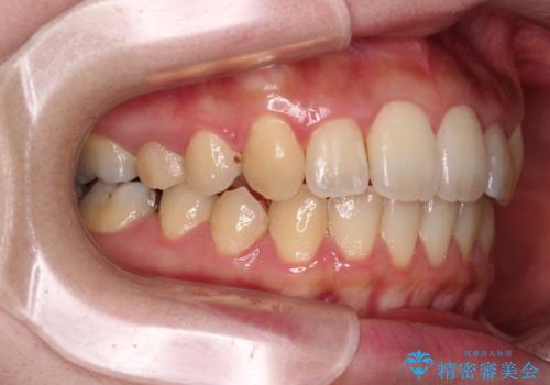 捻れた前歯をインビザラインでスッキリとの治療後