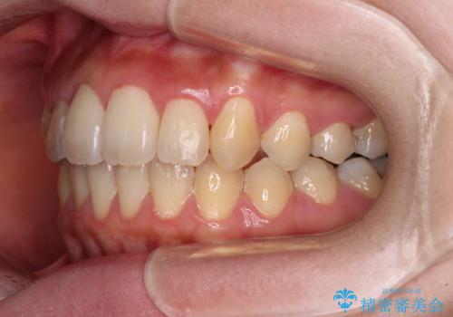 捻れた前歯をインビザラインでスッキリとの治療後