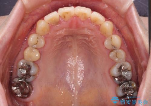 捻れた前歯をインビザラインでスッキリとの治療後