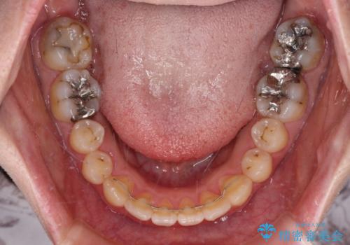 捻れた前歯をインビザラインでスッキリとの治療後