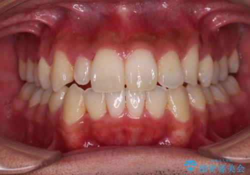 【モニター】左右のクロスバイトをインビザラインできれいに改善の治療中