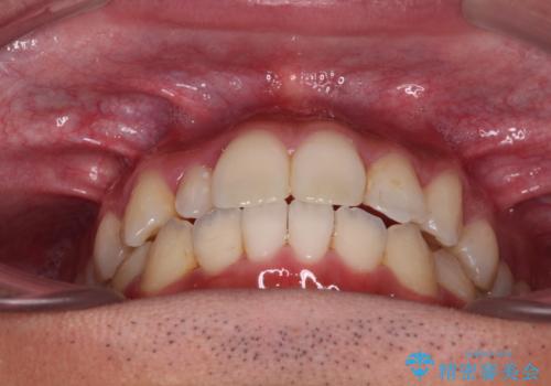【モニター】左右のクロスバイトをインビザラインできれいに改善の治療中