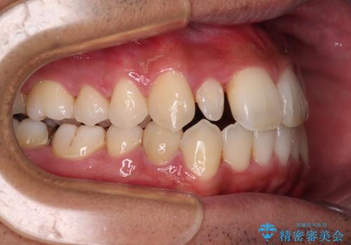 【モニター】左右のクロスバイトをインビザラインできれいに改善の治療中