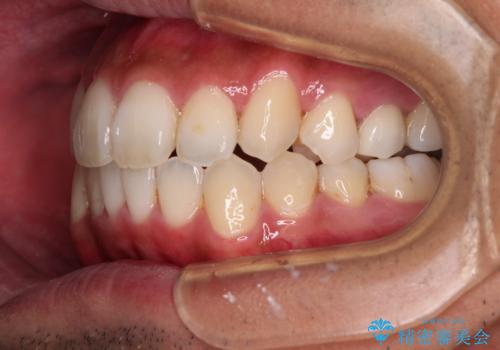 【モニター】左右のクロスバイトをインビザラインできれいに改善の治療中