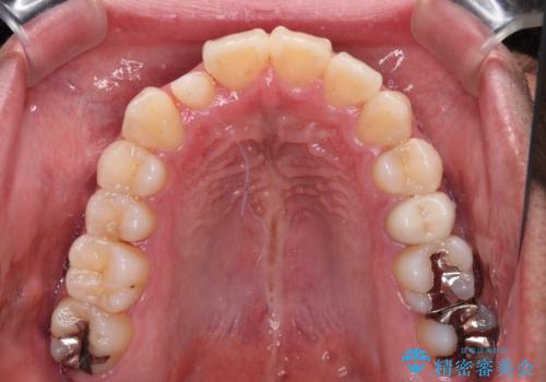 【モニター】左右のクロスバイトをインビザラインできれいに改善の治療中