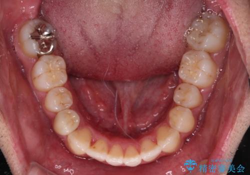 【モニター】左右のクロスバイトをインビザラインできれいに改善の治療中