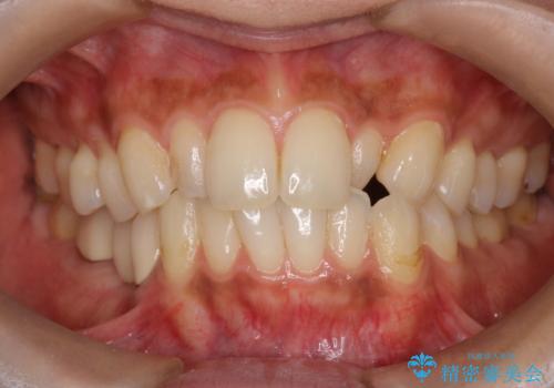 前歯クラウン(オールセラミック)の症例 治療前