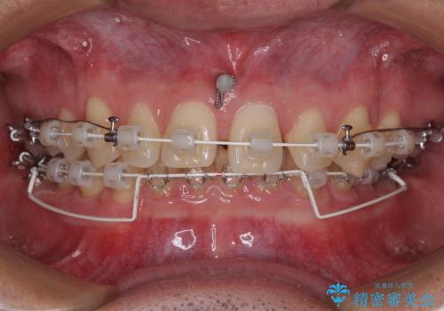 著しいディープバイトと隙間だらけの歯列 の治療中
