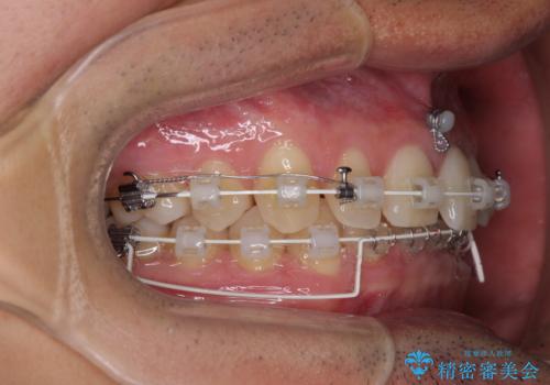 著しいディープバイトと隙間だらけの歯列 の治療中