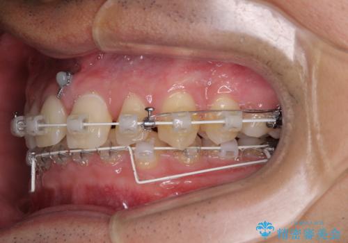 著しいディープバイトと隙間だらけの歯列 の治療中
