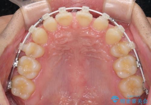 著しいディープバイトと隙間だらけの歯列 の治療中