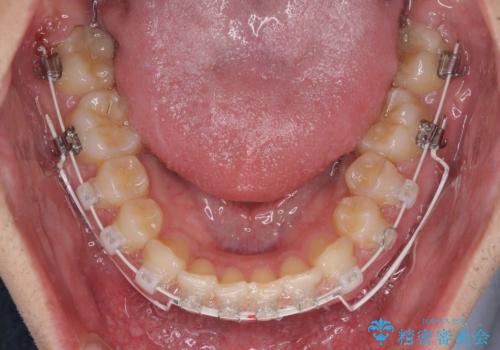著しいディープバイトと隙間だらけの歯列 の治療中