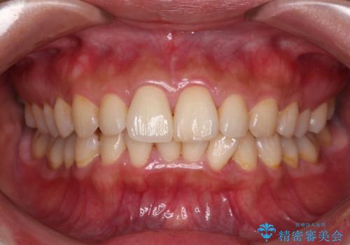 転んで欠けてしまった前歯 オーダーメイドのオールセラミッククラウンの治療後