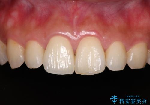 転んで欠けてしまった前歯 オーダーメイドのオールセラミッククラウンの症例 治療後
