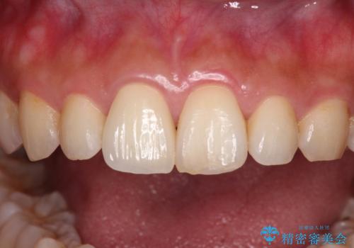 転んで欠けてしまった前歯 オーダーメイドのオールセラミッククラウンの治療後