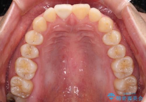 転んで欠けてしまった前歯 オーダーメイドのオールセラミッククラウンの治療後