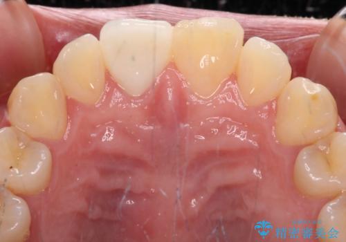 転んで欠けてしまった前歯 オーダーメイドのオールセラミッククラウンの治療後