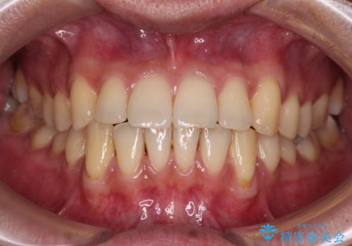 ワイヤー装置での上下前歯の部分矯正の症例 治療後