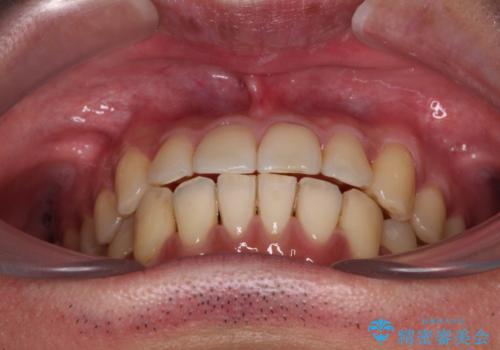 ワイヤー装置での上下前歯の部分矯正の治療後