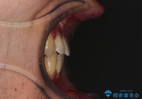 ワイヤー装置での上下前歯の部分矯正の治療後