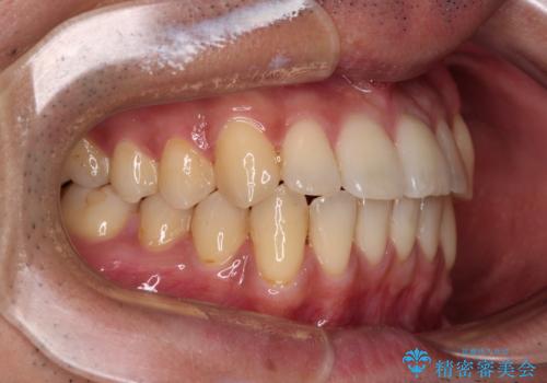 ワイヤー装置での上下前歯の部分矯正の治療後