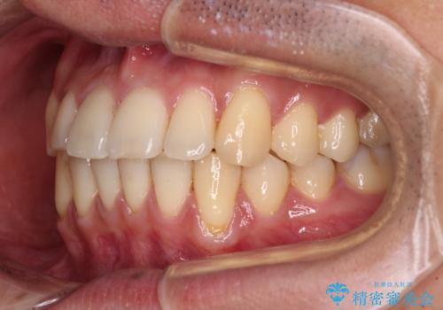 ワイヤー装置での上下前歯の部分矯正の治療後