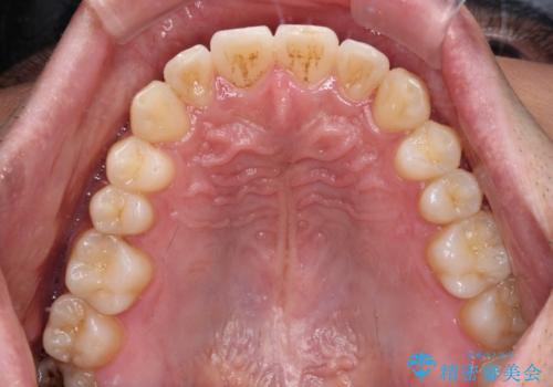 ワイヤー装置での上下前歯の部分矯正の治療後