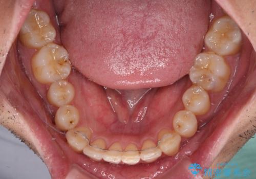 ワイヤー装置での上下前歯の部分矯正の治療後