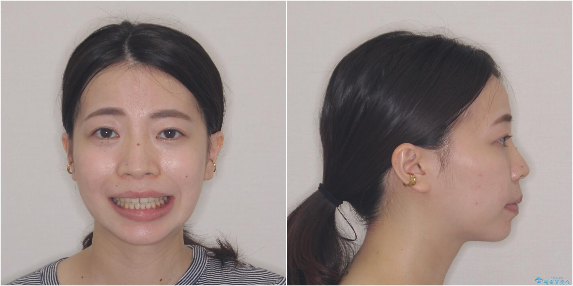 【モニター】短期間で口の閉じにくさを改善　ワイヤー装置での抜歯矯正の治療後（顔貌）