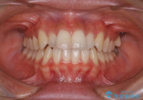 前歯のがたつきを改善してしっかり噛める歯並びへ:インビザライン治療の症例 治療前